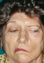 implantes dentales
